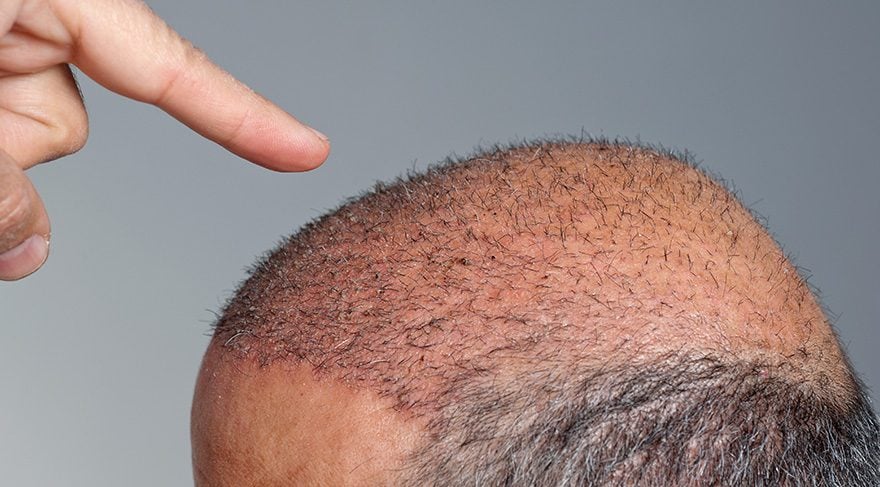 Hair Transplant in Dubai