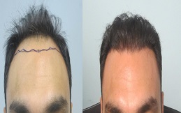 عيادات تقدم استشارات مجانية لزراعة الشعر في دبي