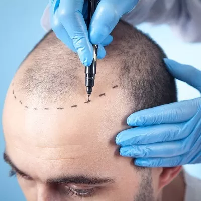 Post-Hair Transplant Care: Tips for Faster Healing in Dubai