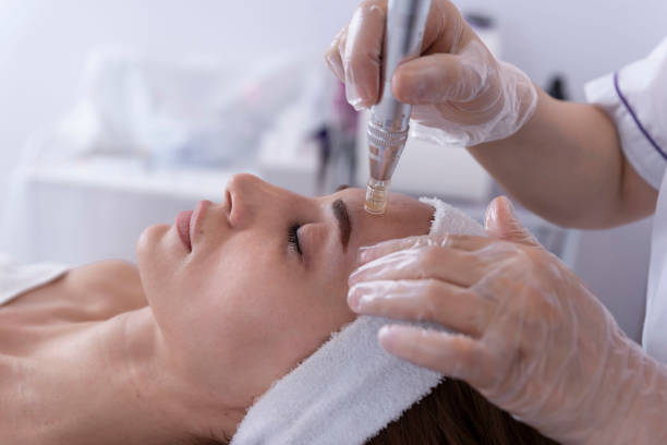 Micro needling treatment in Islamabad