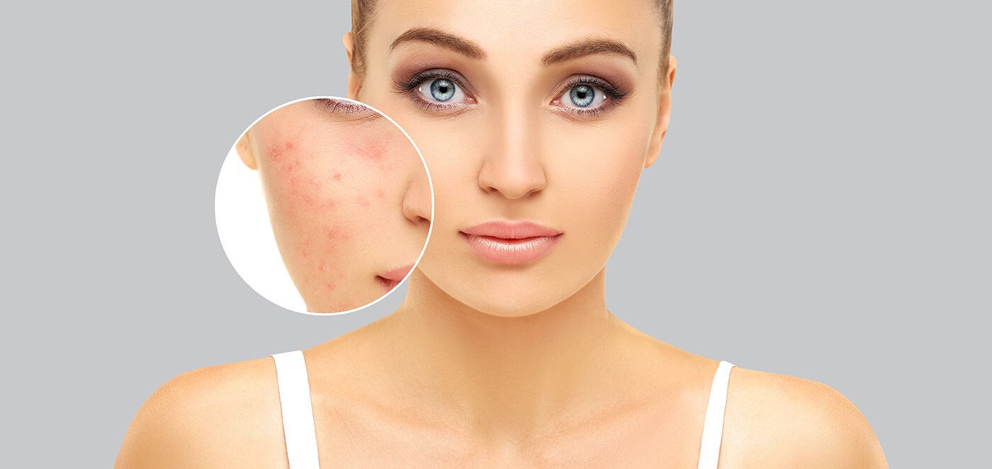 Freckle Removal in Islamabad: Best Treatment Options