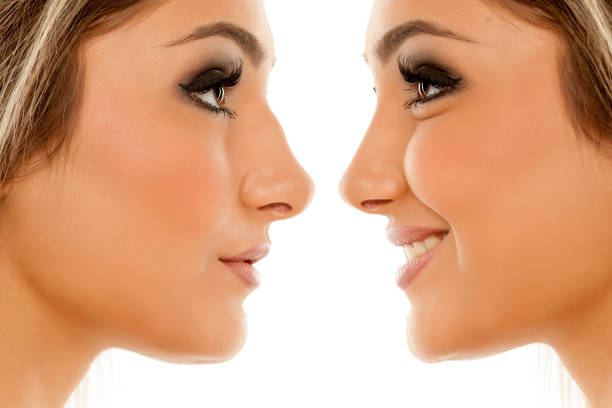 Tips for a Smooth Rhinoplasty Recovery in Islamabad