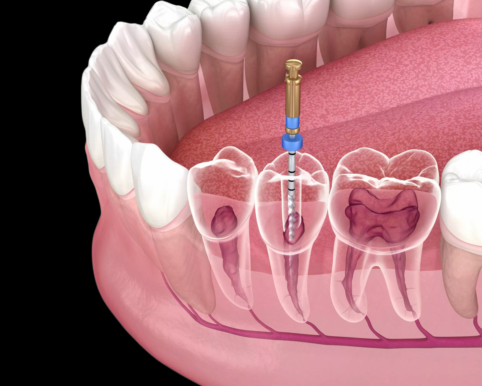 How Root Canal Treatment Can Save Your Natural Teeth in Islamabad