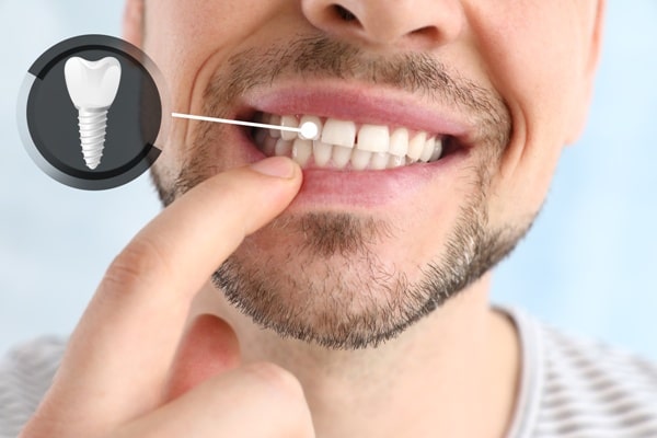 Immediate Load Dental Implants in Islamabad: Are They Worth It?