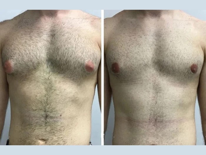 Gynecomastia Surgery in Dubai: Step-by-Step Treatment Guide