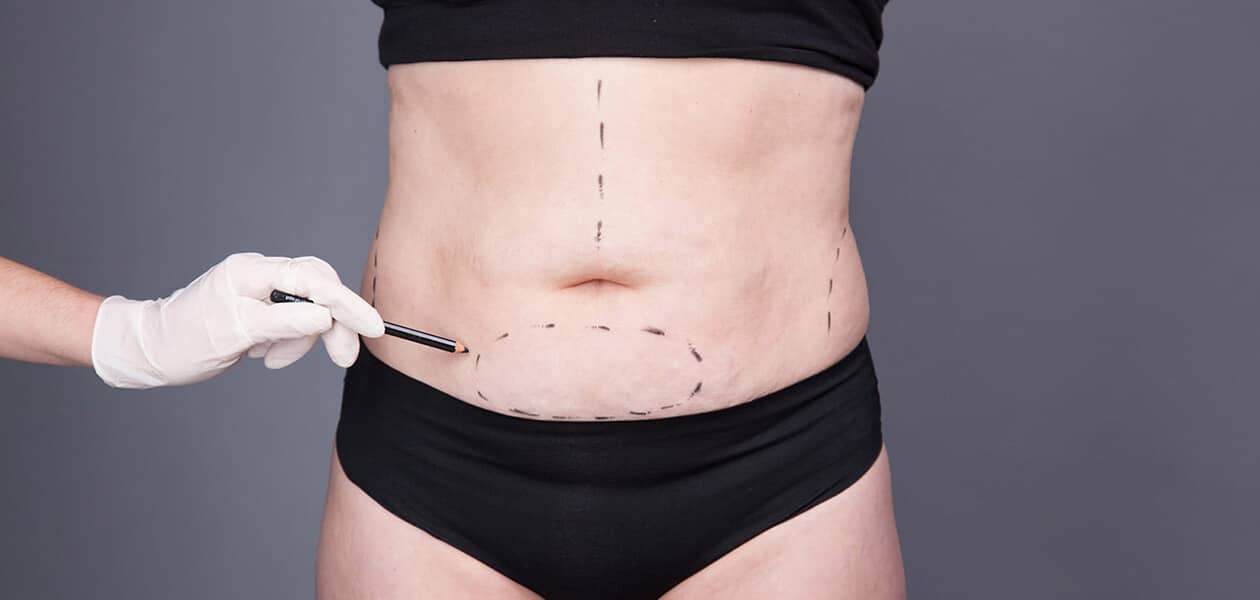 Why a Tummy Tuck Works for Moms Post-Baby?