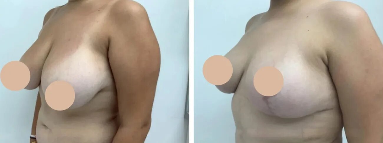 breast lift in dubai