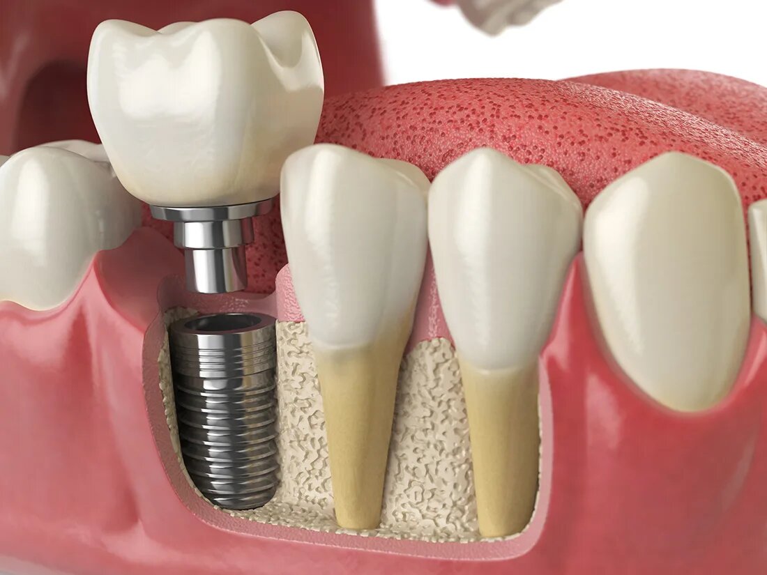 dental implants in London