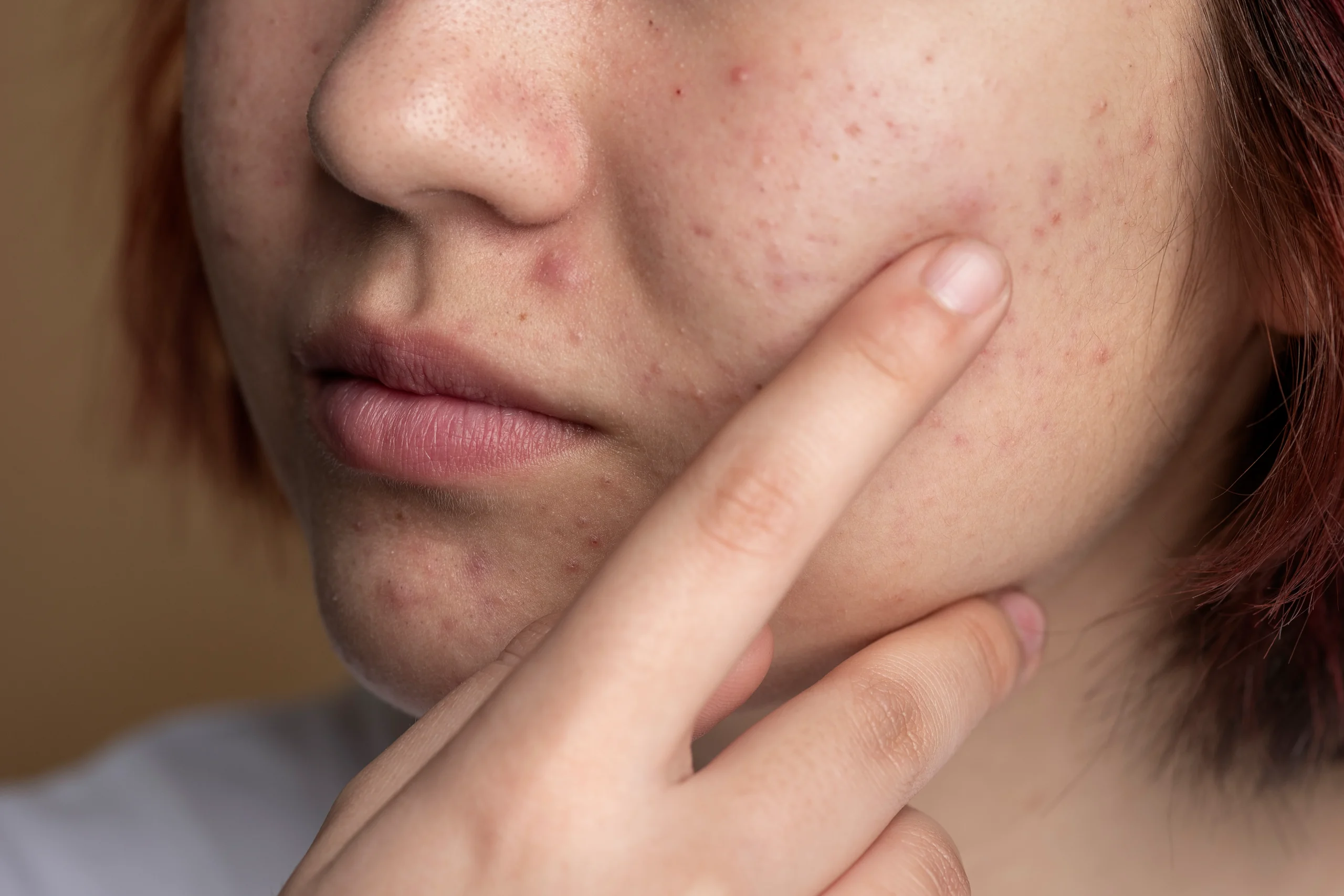 Does Acne Scar Treatment Require Downtime?