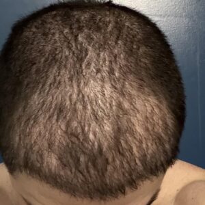 Is Crown Hair Transplant Right for You