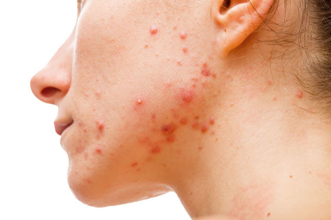 What Happens After Acne Treatment Ends