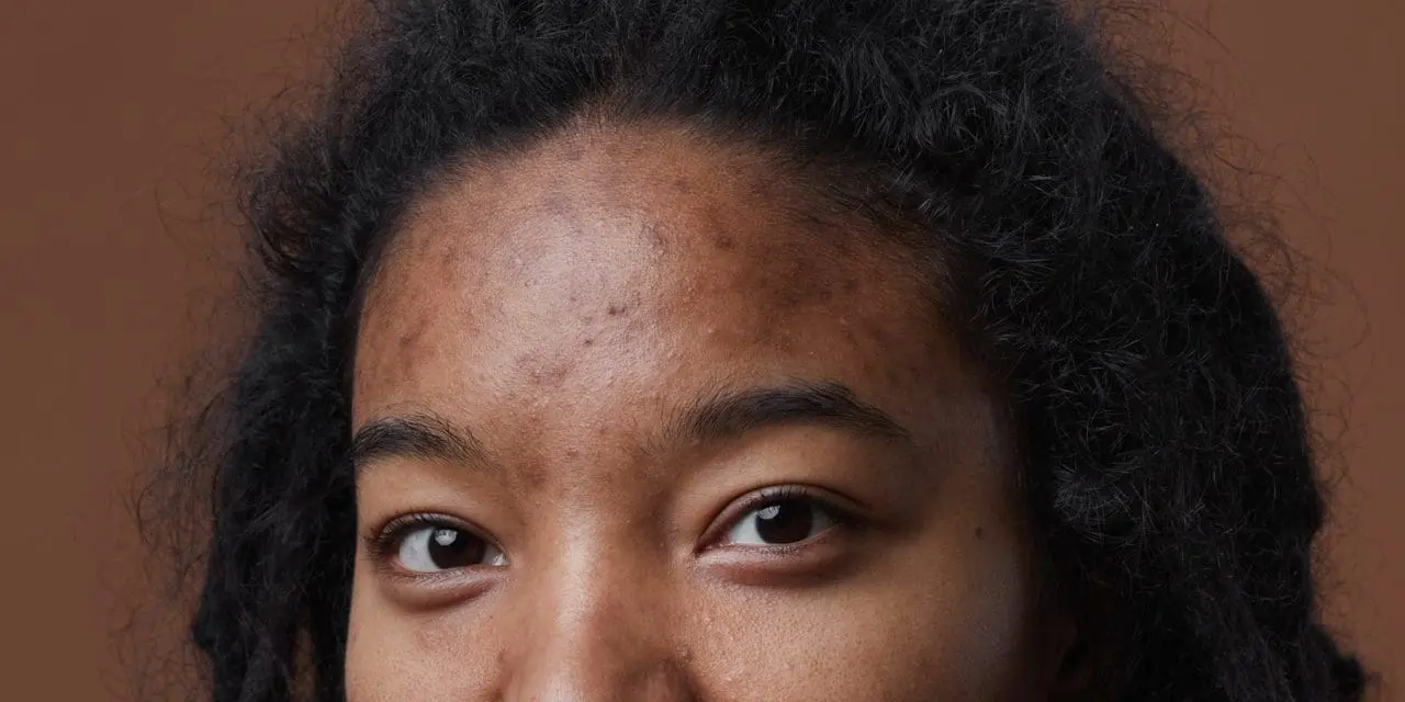 does weed give you acne