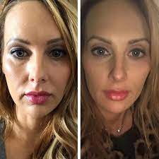 How to Find the Best Plastic Surgeons in Dubai for Thread Lift Excellence