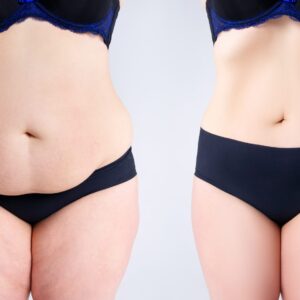 Fat Transfer in Dubai: A Natural Solution for Breast Enhancement