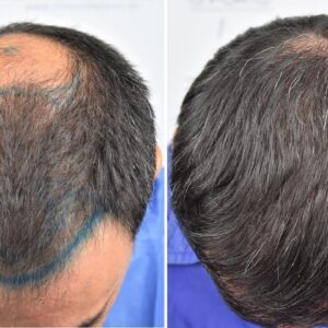 Crown hair transplant in Islamabad