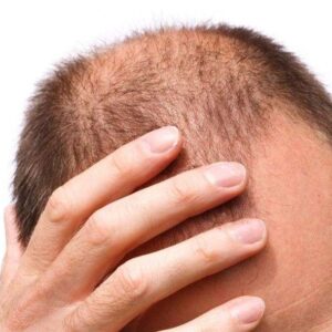 Does 1 Dirham Hair Transplant Include Consultation
