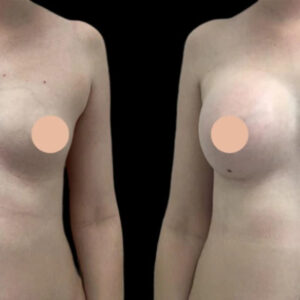 Breast Augmentation in Dubai