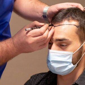 Hair Transplant in Islamabad pakistan