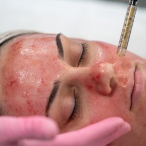 Vampire Facial in Dubai