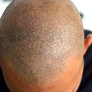 Is Enfield Royal Clinic Best for Hair Transplants