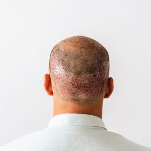 Is Hair Transplant Better Than Hair Patches