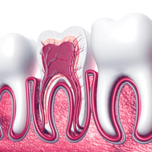 Root Canal Treatment in Islamabad