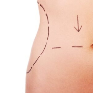 Tummy Tuck in Islamabad