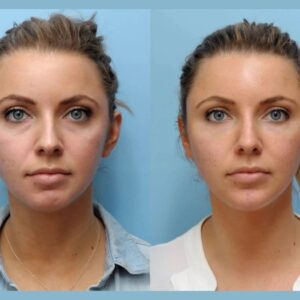 Best Aesthetic Clinics in Dubai for Thread Lift: Aftercare Tips for Optimal Results