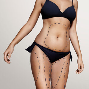 liposuction