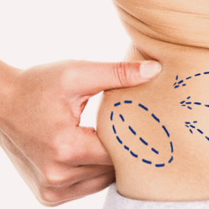vaser 4D liposuction in dubai