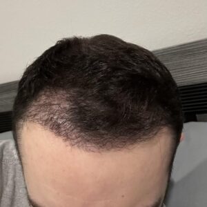 Advanced Hair Regrowth Techniques Now