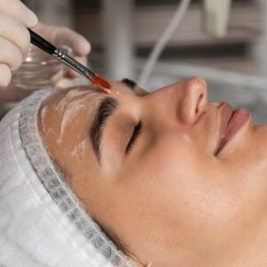 Does a Chemical Peel Reduce Fine Lines Too?