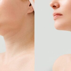 Double chin removal in Islamabad
