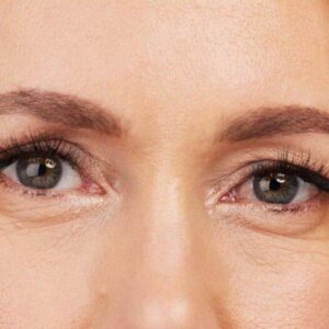 Eyelid Surgery The Secret to Younger-Looking Eyes