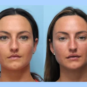 How the Best Plastic Surgeons in Dubai Achieve Natural Thread Lift Results