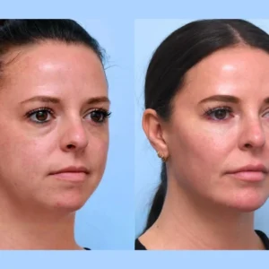 Best Plastic Surgeons in Dubai: Choosing the Thread Lift Safe and Effective