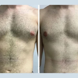 Understanding the Cost Breakdown of Gynecomastia in Dubai