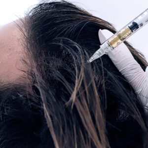 Best PRP Hair Treatment in Dubai