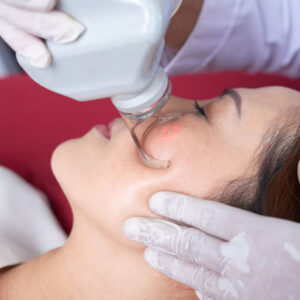 Is Pico Laser Treatment Better Than CO2 Laser?