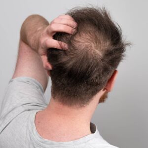 Is Scalp Micropigmentation Good for Patchy Hair?