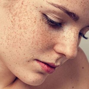 Melasma Treatment in Islamabad