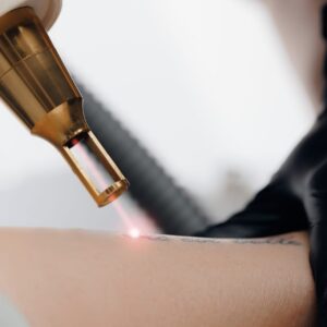 Laser Tattoo Removal in Dubai