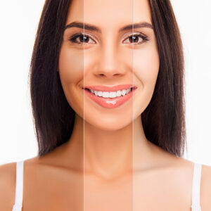 Skin whitening in Islamabad