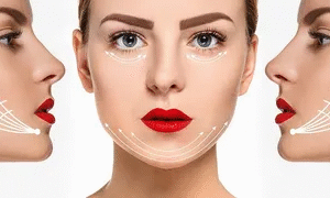 Thread lift for jawline Islamabad