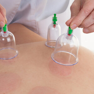 Hijama in Dubai