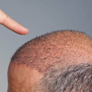 Hair Transplant in Dubai,Hair Transplant Dubai