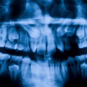 Panoramic Dental X-Ray Cost in Dubai