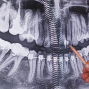 Panoramic Dental X-Ray Cost in Dubai