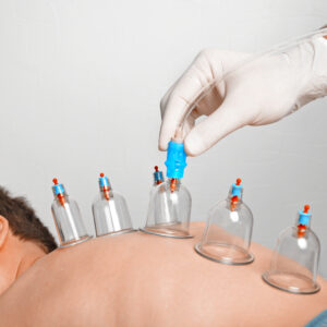 Hijama Cupping Therapy in Dubai
