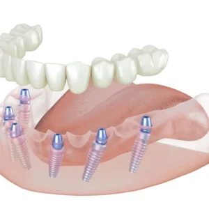 implants dentaires prix